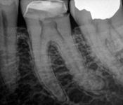 Preoperative