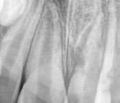 Necrosis of #9 
Treatment: Revascularization with Antibiotics