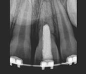 3 Year Recall: Complete Bone Formation
