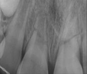 Horizontal Root Fractures of #8 and #9