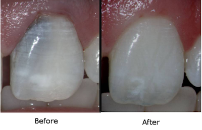 Internal Tooth Bleaching